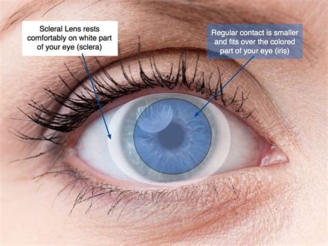 Regain Your Clear Vision and Comfort with the Help of a Specialist Optometrist for Scleral Contact Lenses for Dry Eyes